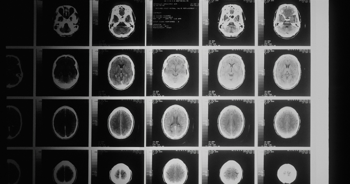 Zagađenje zraka povećava rizik od razvoja Parkinsonove bolesti