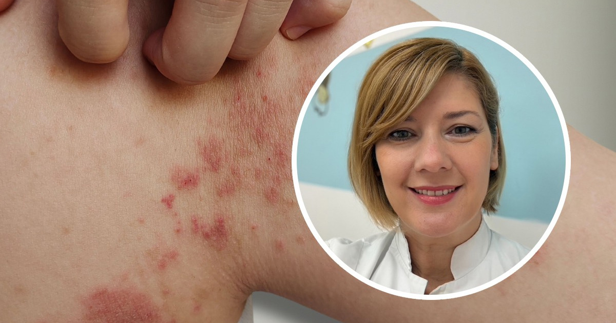 Što su slatke kraste i kako ih prepoznati? Razgovarali smo s pedijatricom